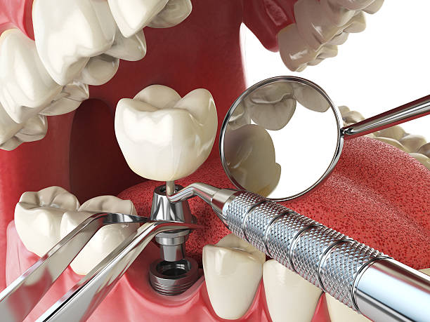 Best Emergency Wisdom Teeth Removal in Nsfield Center, MA